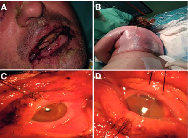 Figure 2 - Mucosal involvement in toxic epidermal necrolysis and skin coverage. A) Oral and labial mucosa involvement