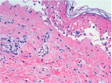 Figura 3 - Histología de la necrolisis epidérmica tóxica. Necrosis confluente de  queratinocios epidérmicos con despegamiento dermo-epidérmico (HE x 120).