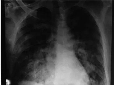 Figure 1 - Initial chest X-ray.