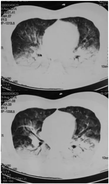 Figure 3 - Chest X-ray: outpatient follow-up.