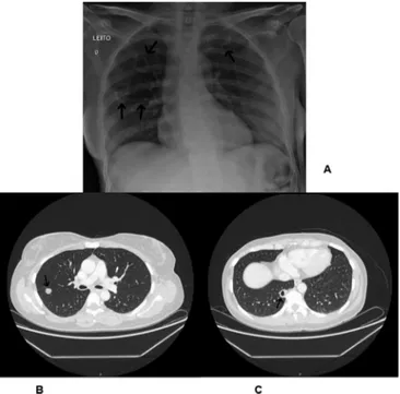 Figure 1 - (A) Chest radiography in PA view showing bilateral nodules (patient  previously diagnosed with Poliangiitis granulomatosis)