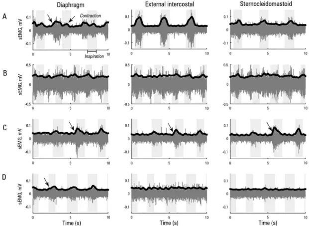 Figure 1 - Surface electromyography from the diaphragm, external intercostal and sternocleidomastoid muscles recorded during the weaning  tests: (A) first, (B) second, (C) third and (D) fourth attempt