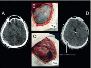 Figura 2 - Imagem de tomografia computadorizada do crânio e exames ultrasso- ultrasso-nográficos após a cirurgia