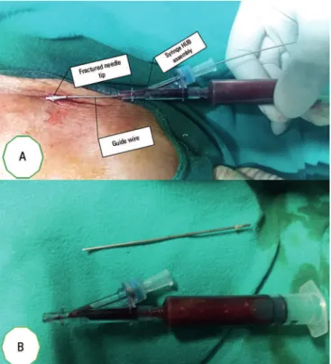 Figure 1 - (A) Tip of the introducer needle with the guide wire in place. (B) Close  inspection of the introducer needle and hub syringe assembly.