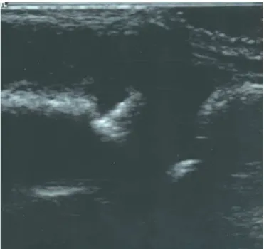 Figure 2 – An erosion seen on the dorsal aspect of the left third metacar- metacar-pophalangeal joint of the same patient as in figure 1.