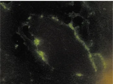 Figure 2 - Immunofluorescence of a skin biopsy with vasculitis showing deposition  of IgA (Patient 4).
