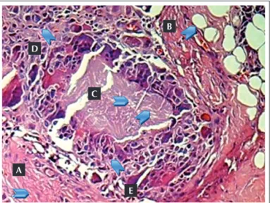 Figure 2. Hematoxylin-eosin stain: node surrounded by dense ibrous connec - -tive collagenous tissue (A), hypervascularized, partially surrounded by adipose  tissue (B)