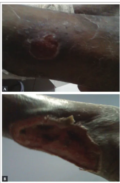 Figure 2. Ulcerated lesions with elevated borders, hyperemia, and signs  of necrosis of the left ankle (A), which are deeper and more extensive in  the lower third and dorsal aspect of the right foot (B).