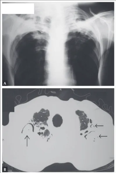 Figure 1.  A) Preoperative posteroanterior chest X-ray showing  chronic lesions in both apices