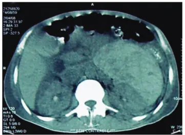 Figure 1. Right kidney: Hypoechoic image with clearly deined borders,  measuring 2.5 cm, in the medial third of the kidney