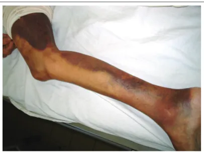 Figure 1. Hematoma and extense ecchimosis of a lower limb.