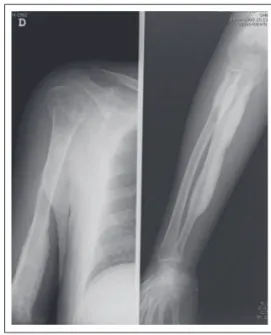 Figure 2. Cortical sclerosis and thickening of leg bones,  more evident in the right tibia.