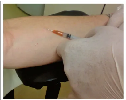 Figure 1. PPD inoculation technique performed approximately 4 ingers under  the elbow.