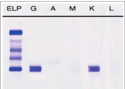 Figure 2 (A) – Presence of Kappa monoclonal protein.