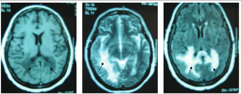 Figure 1. MRI of the head showing right temporal-parietal-occipital and left parietal-occipital lesions, affecting especially the periventricular white  matter, with hypointense signal, in T1, and hyperintense signal, in T2, and lair, respectively.