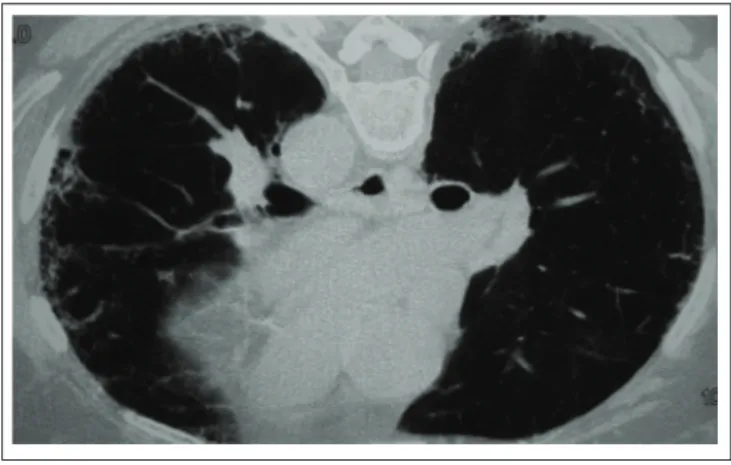 Table 1 Chest HRCT fi ndings in 71 patients with rheumatoid arthritis