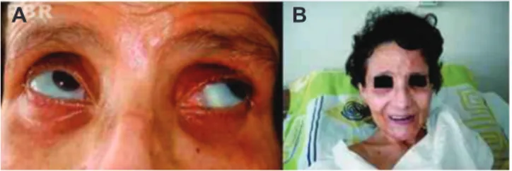 Fig. 1 – A, Blueish sclera in patient with osteogenesis  imperfecta associated with juvenile idiopathic arthritis