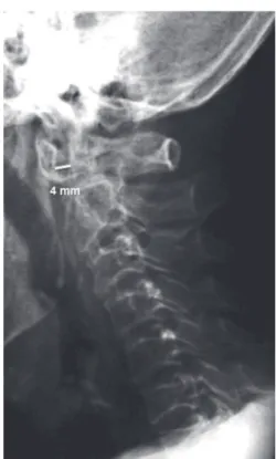 Fig. 3 – Lateral cervical spine radiographs in the neutral  position (A), hyperextension (B), and hyperfl exion (C)