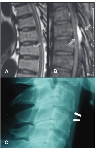 Fig. 1 – (A and B) MRI of thoracic spine on lateral  view. Note the presence of a low signal lesion in T1  indicated by the arrows (A) before and (B) after contrast  administration, with a homogeneous enhancement