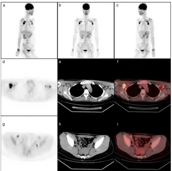 Figure 1 – 18 F-FDG PET of a female patient, 28 years old, complaining of symmetrical polyarthralgia, especially involving hands and wrists and associated with prolonged morning stiffness