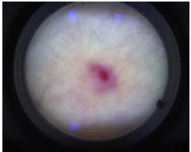 Figure 1 – The dermatoscopic aspect of a pathergy test.