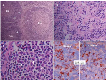 Fig. 1 – Abdominal lymph node biopsy showed histological  indings consistent with Castleman’s disease, plasmacytic  variant