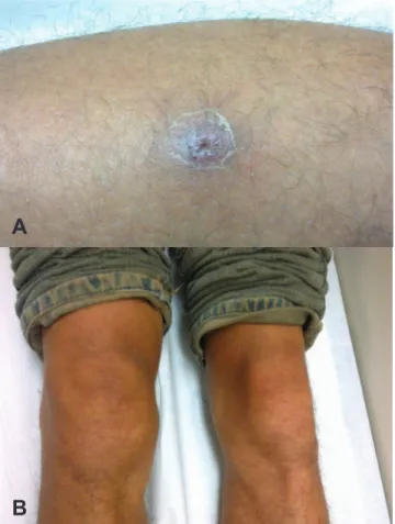 Fig. 1 – (A) Inoculation eschar on the left leg of a patient  with mild Brazilian spotted fever and acute knee  monoarthritis