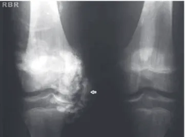 Fig. 1 – Calcinosis lesion on the right knee.