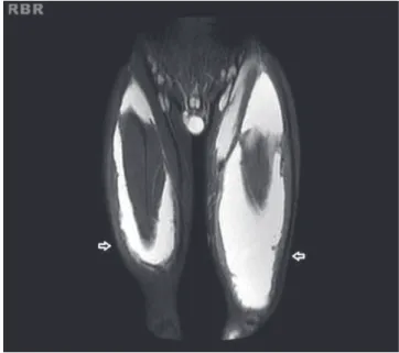 Fig. 2 – “Milk of calcium” - hyperintense on STIR image.