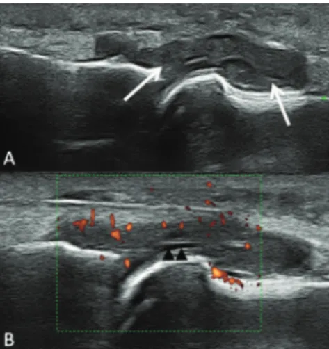 Fig. 1 – A, Grayscale ultrasound examination of dorsal  aspect. B, Power doppler imaging increased color signals.
