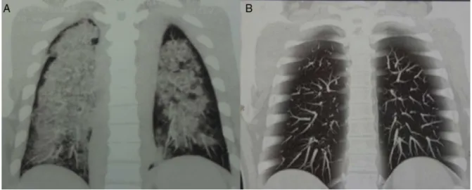 Fig. 1 – Chest CT coronal reconstruction of patient 1. (A) View prior to treatment, showing diffuse opacities compatible with diffuse alveolar hemorrhageand pulmonary capillaritis