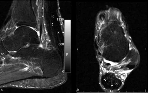 Figure 2 – STIR magnetic resonance imaging of the Achilles tendo in a patient with a xanthoma