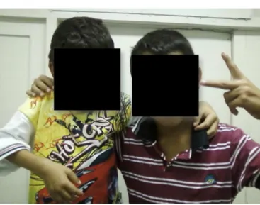 Fig. 1 – Siblings with polyarticular JIA; case report 1.