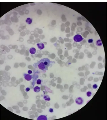 Fig. 1 – Hemophagocytosis in the bone marrow.