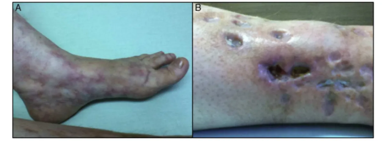 Figura 1 – Livedo racemoso em pé esquerdo e úlceras em perna direita.
