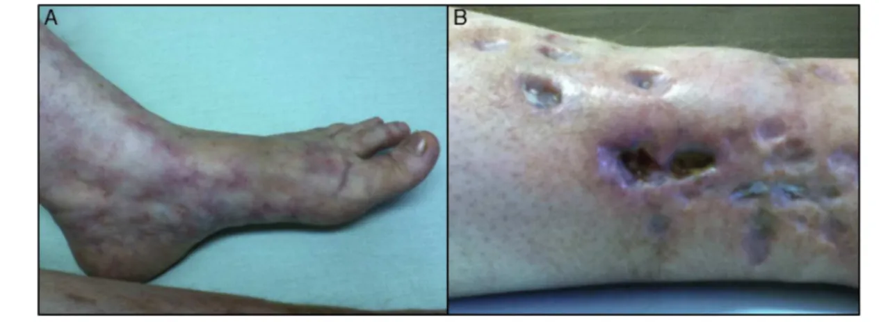 Fig. 1 – Livedo Racemosa on a left foot, and ulceration in right leg.