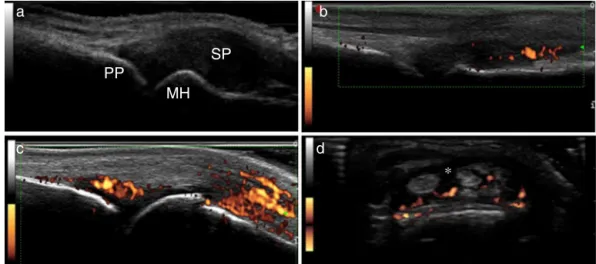 Fig. 1 – Inflammation parameters of US10. (A) Synovial proliferation grade 3; (B) synovitis by power Doppler grade 2; (C) synovitis by power Doppler grade 3; (D) tenosynovitis by power Doppler