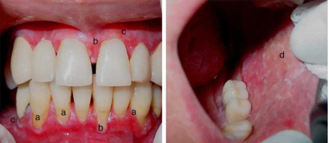Fig. 2 – Patient with systemic lupus erythematosus with gingival and tooth sensitivity complaint