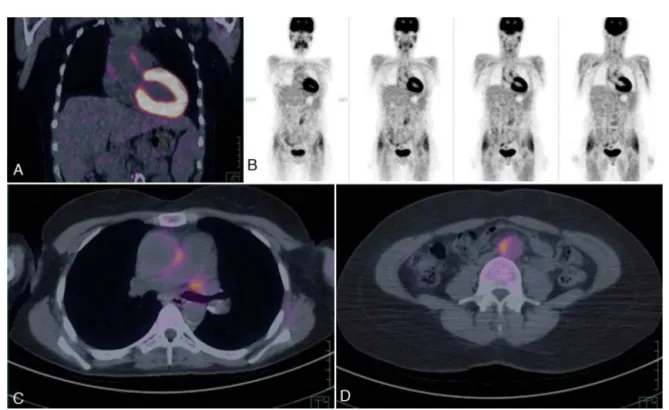 Fig. 3 – Representative PET–CT scan images from a patient with Takayasu arteritis and active disease.
