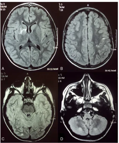 Figure 1 – MRI showing gliosis (A), paramagnetic contrast enhancement in the leptomeningeal compartment (left precentral sulcus, left central sulcus, right occipital sulcus – B and C) and hyperintense lesions involving inferior aspect of the