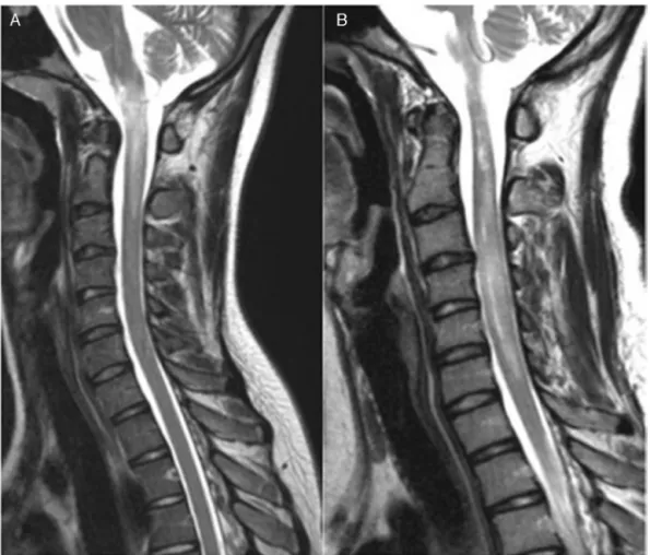 Fig. 1 – Sagittal T2-weighted images showing hyperintensity in spinal cord, extending from the bulb to C3 in the first episode (A) and hyperintensity and increased spinal cord volume extending to C5 in the second episode, seven months after the first one (