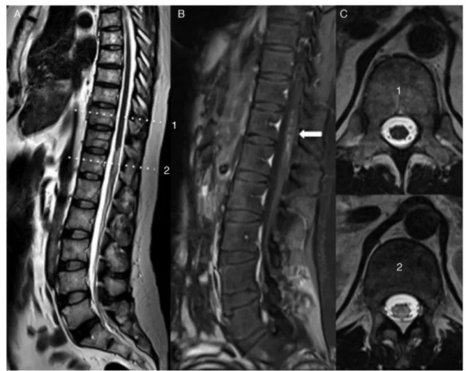 Fig. 2 – Sagittal T2-weighted image, showing hyperintensity and mild enlargement of spinal cord volume, extending from T11 to the medullary cone