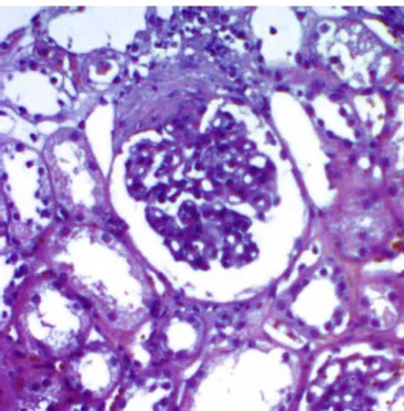 Fig. 1 – Optical microscopy of specimen obtained by renal biopsy revealing mesnagial expansion and hypercelullarity (HE, 200×).