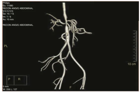 Fig. 1 – Arteriographic alterations.