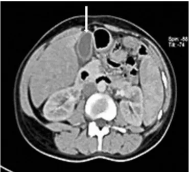 Fig. 1 – Abdominal CT show gallbladder wall thickness without stone with edema around (arrow).