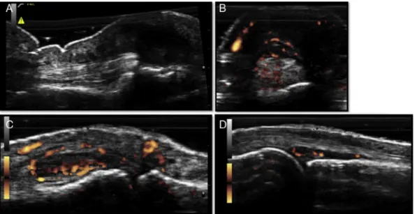 Fig. 1 – (A). Longitudinal US image of the palmar recess of the 1st right interphalangeal (DIP) joint, showing subcutaneous hypoechoic collection involving the flexor digitorum profundus tendon and (B) transverse scan with positive PD signal