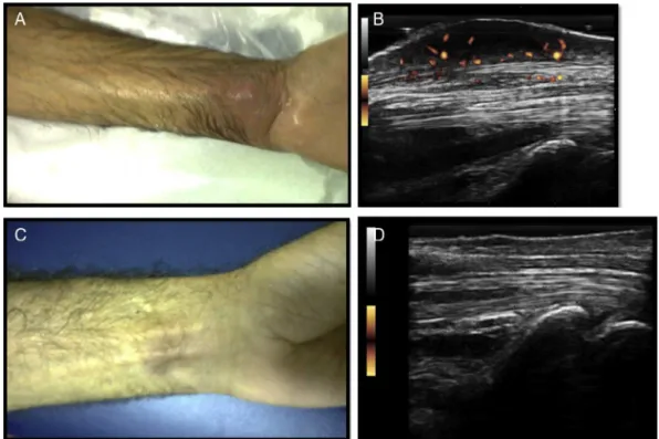 Fig. 2 – (A) Palmar aspect of the left wrist showing a floating lump. (B) US image of the palmar recess, with subcutaneous hypoechoic collection invading flexor tendons and presence of PD signal