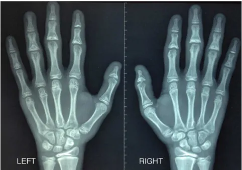 Fig. 2 – Hand radiography showing shortening and widening of the proximal metaphysis and proximal epiphysis triangular shape.