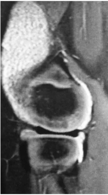 Fig. 2 – Macroscopic aspect of left knee synovium, showing moderate amount of whitish mass, similar to rice grains.