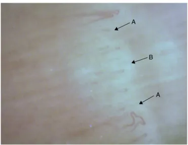 Fig. 1 – Nailfold capillaroscopy showing moderate capillary dilation (arrow A) and mild focal devascularization (arrow B) in patient with juvenile systemic sclerosis.
